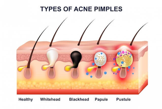 Acne Facial Treatment Singapore - Types of acne pimples - Healthy, Whitehead, Blackhead, Papule, Pustule