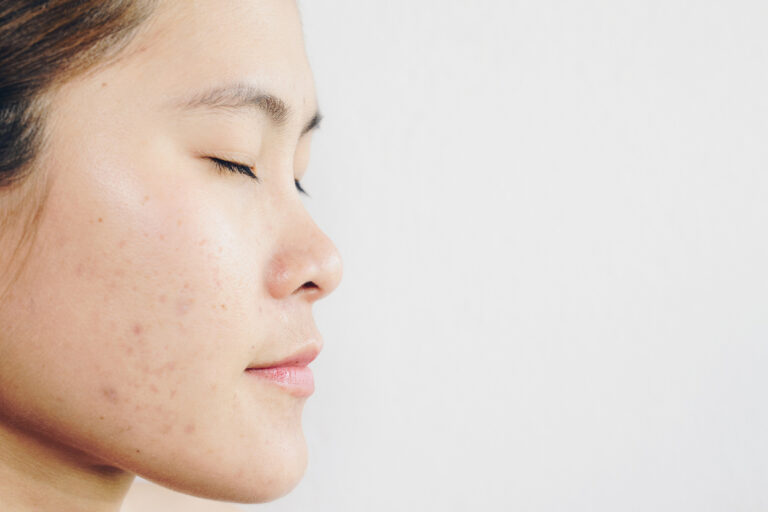 Face Mapping: What Your Breakouts Say About Your Health