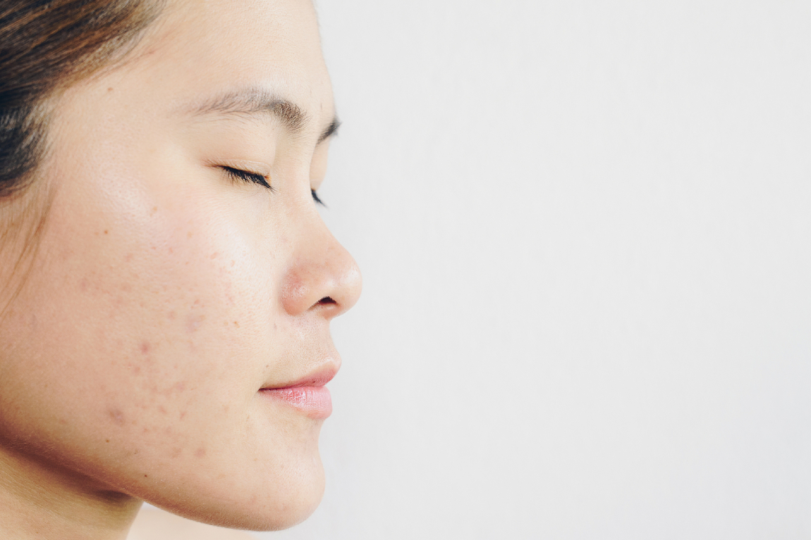 Face Mapping: What Your Breakouts Say About Your Health
