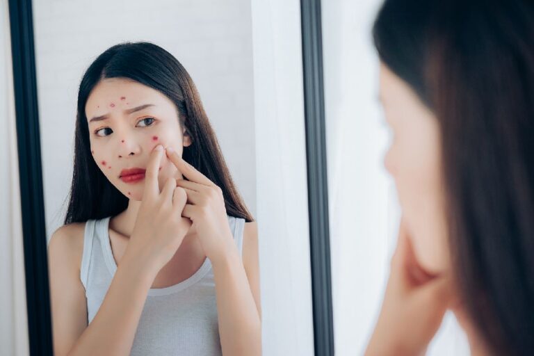 The Hidden Triggers of Adult Acne and How to Avoid Them