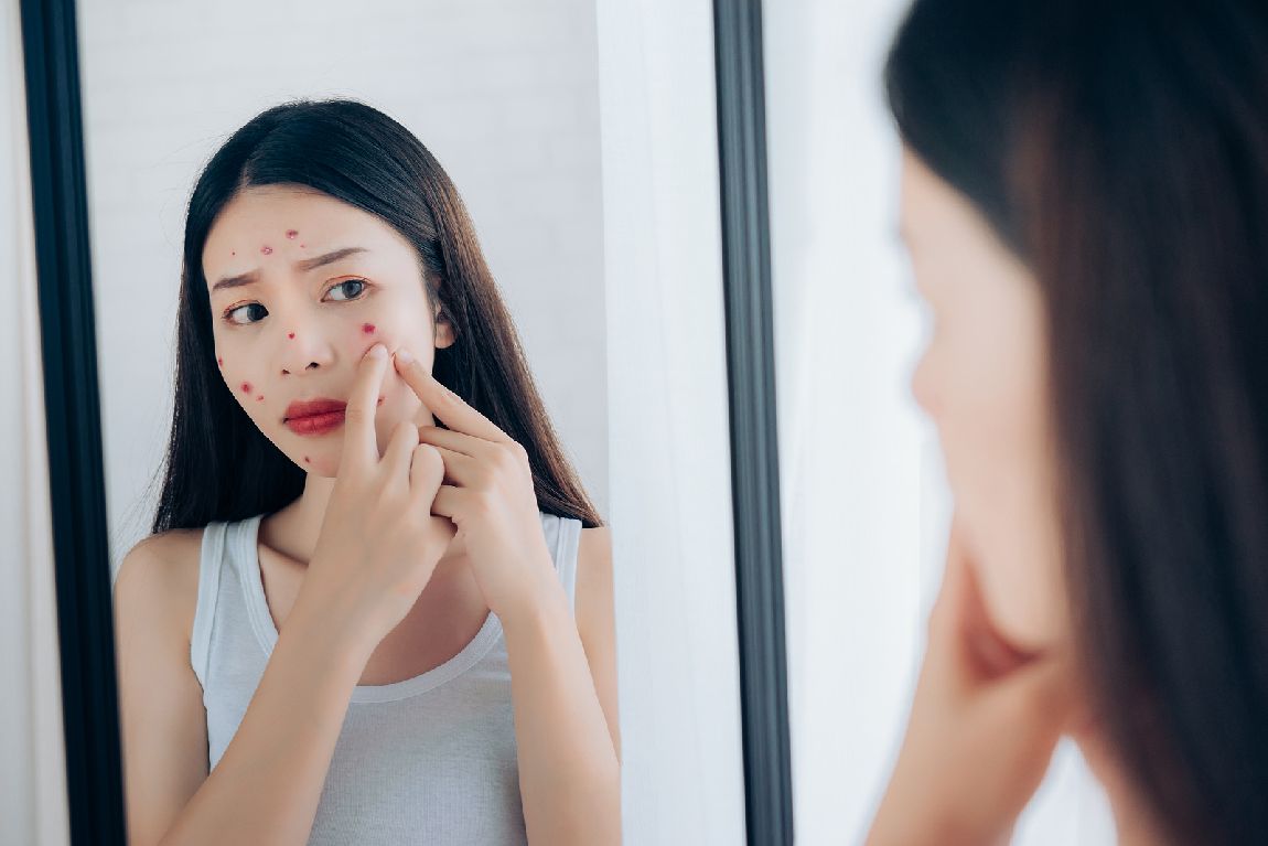 The Hidden Triggers of Adult Acne and How to Avoid Them