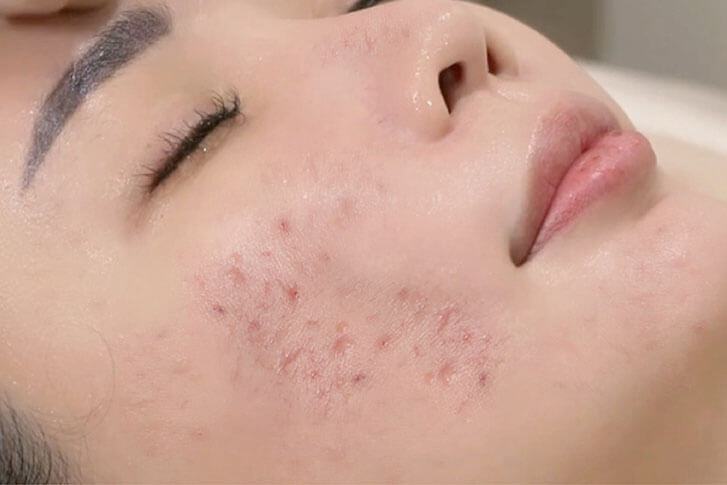 Acne facial treatment designed for acne-prone skin at Adonis Skincare Singapore
