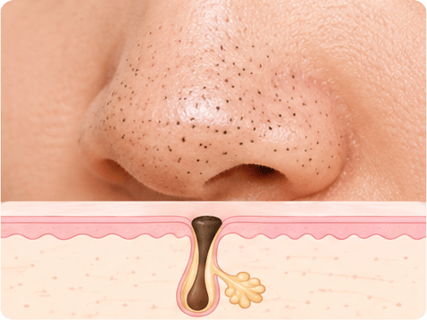 blackheads